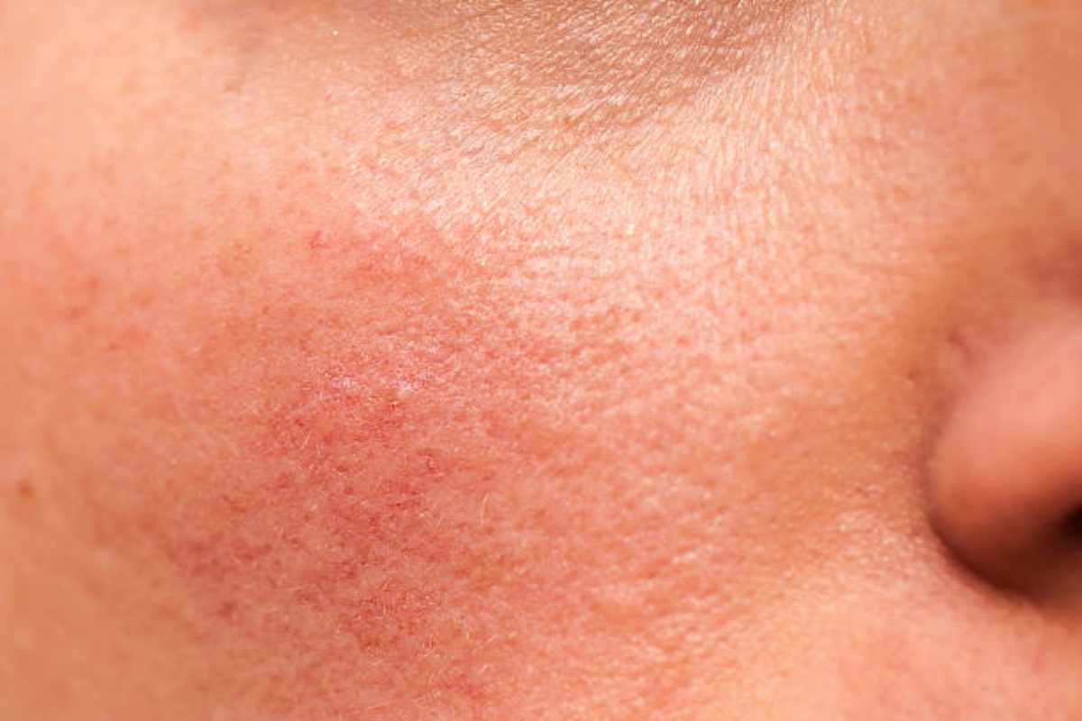 Caso di acne rosacea