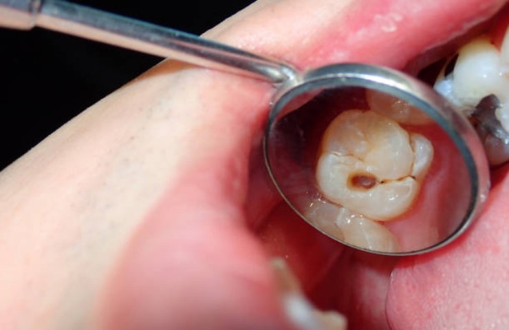 Carie sul dente di un paziente