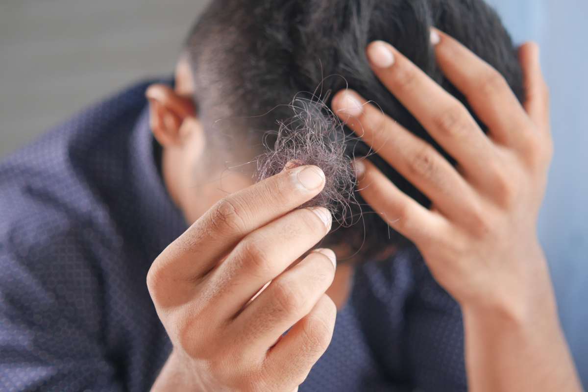 Uomo perde i capelli